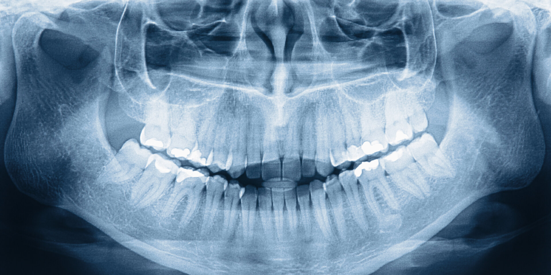 X-ray image of teeth