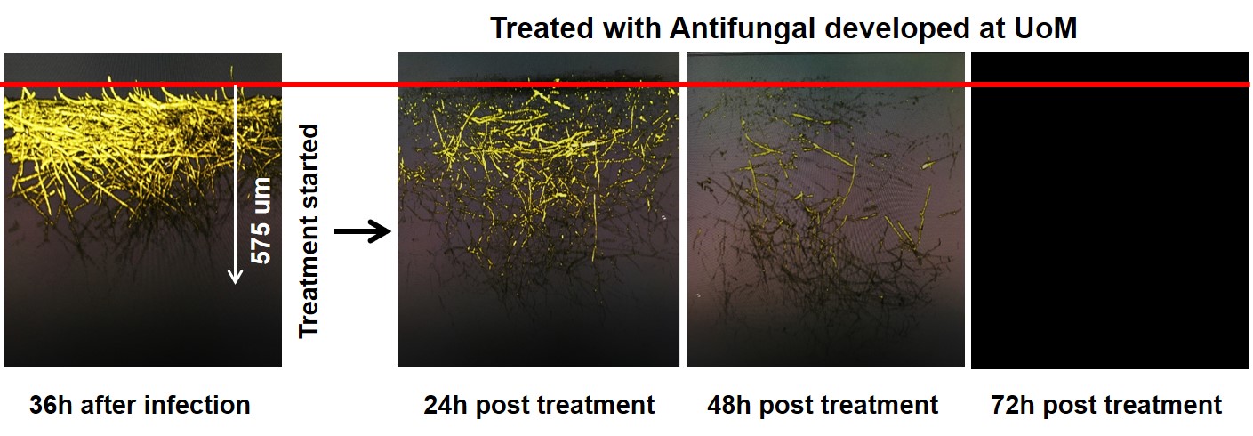 A graph showing the effects of an infected eye treated with antifungus developed at The University of Manchester. 72 hours after treatment, the infection has healed.