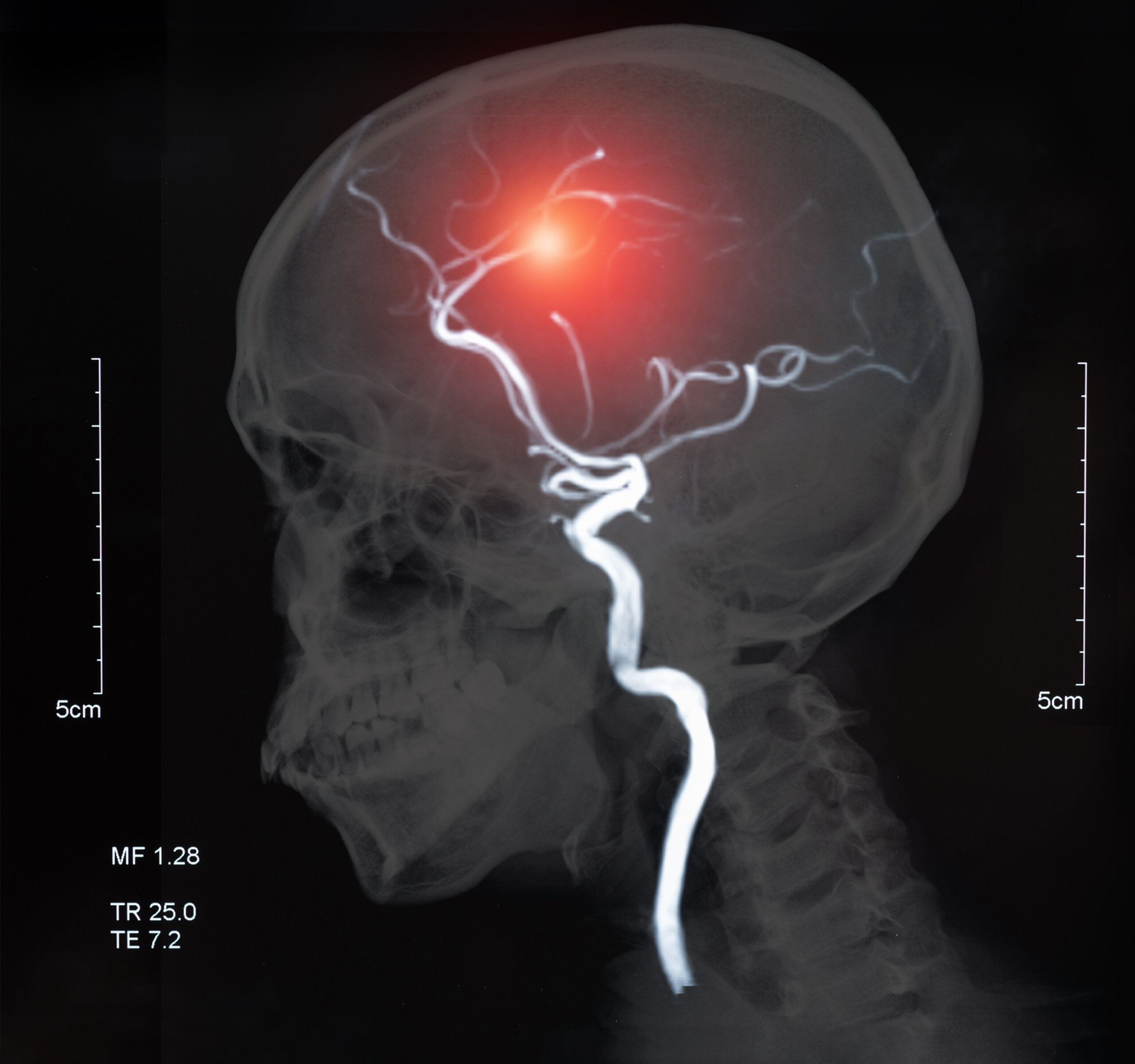 MRI of the blood vessels in the brain