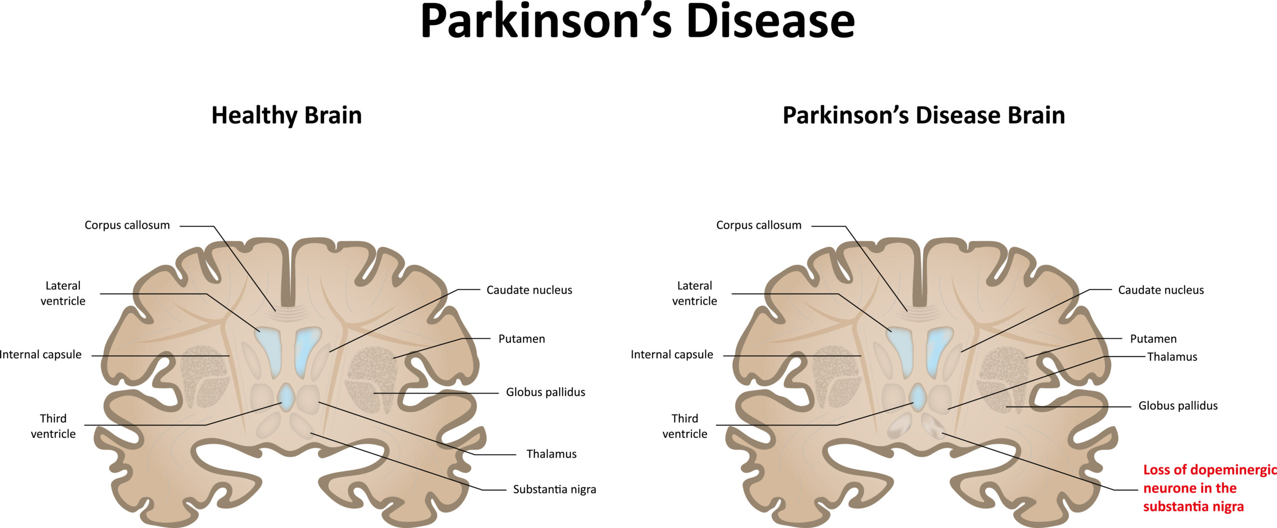 Illustration comparing healthy brain to a brain with Parkinson's