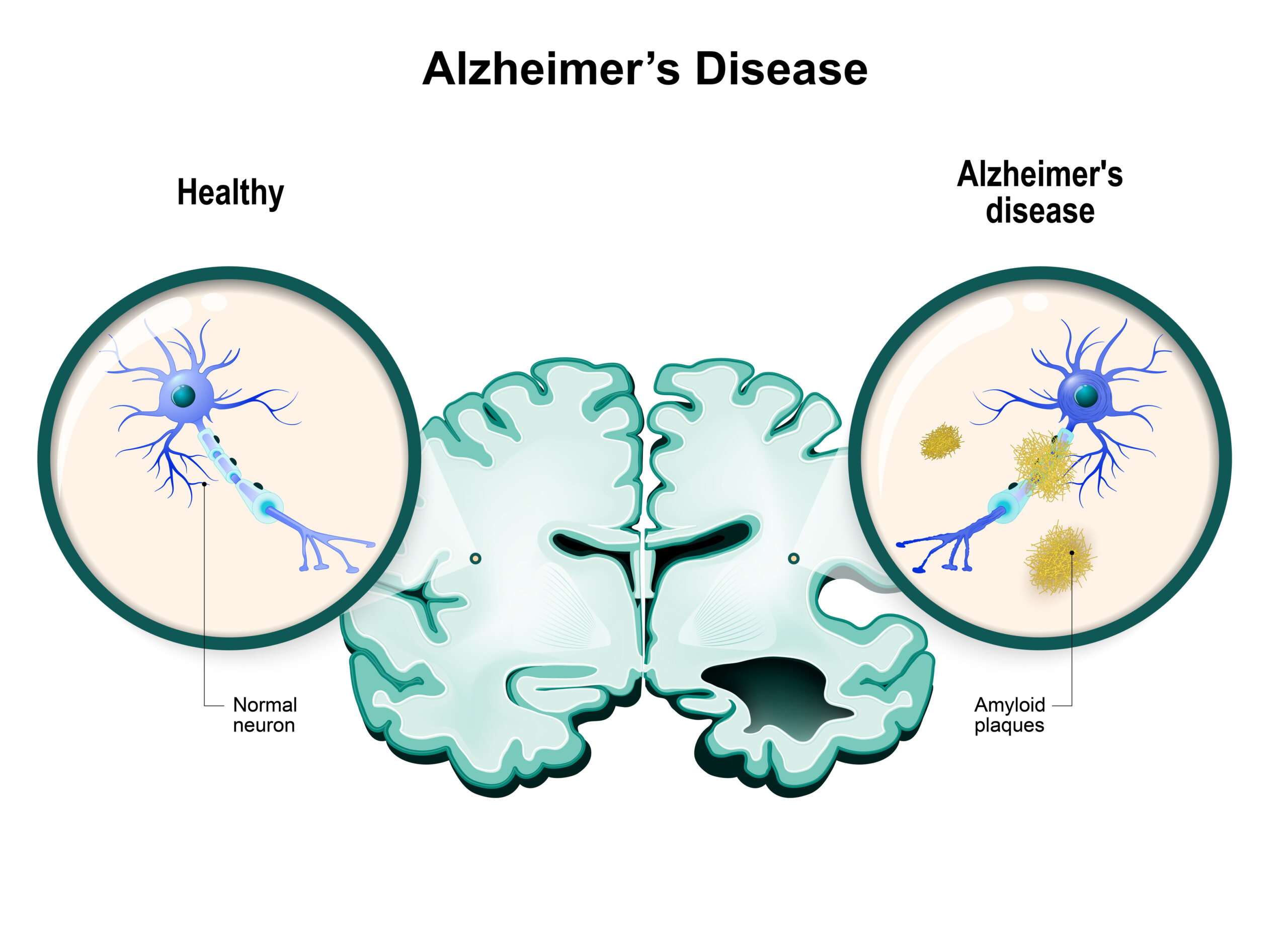 Illustration comparing a healthy human brain and a brain with Alzheimer's disease. Shows a healthy neuron and neuron with amyloid plaques.