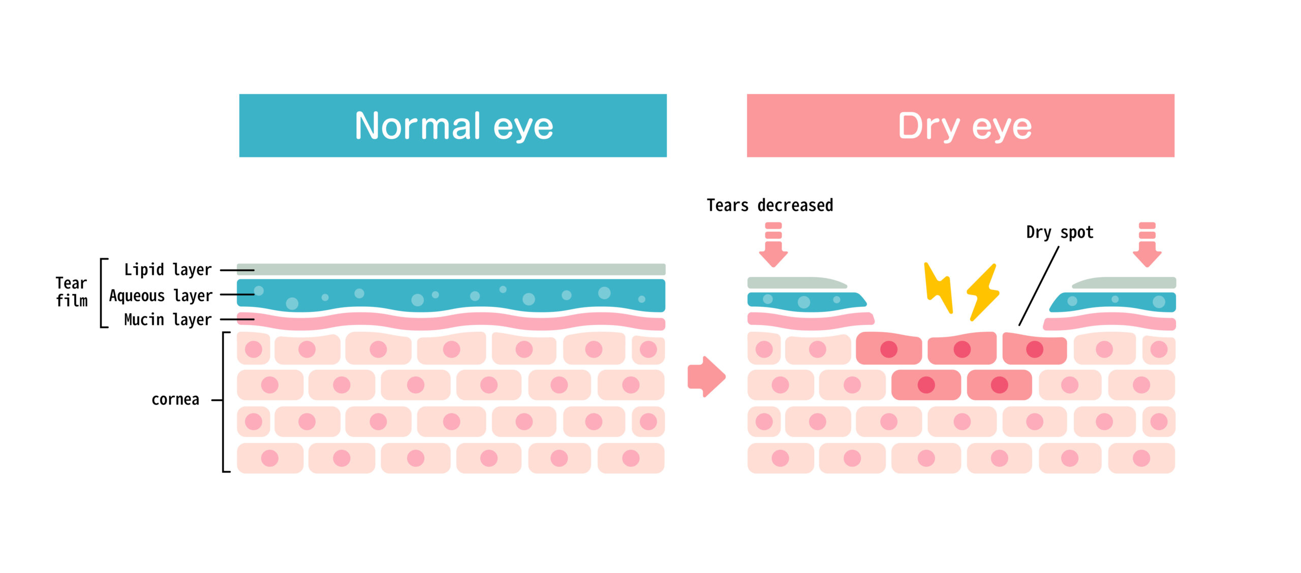Comparison illustration between normal and dry eye. Cross section of eye surface.