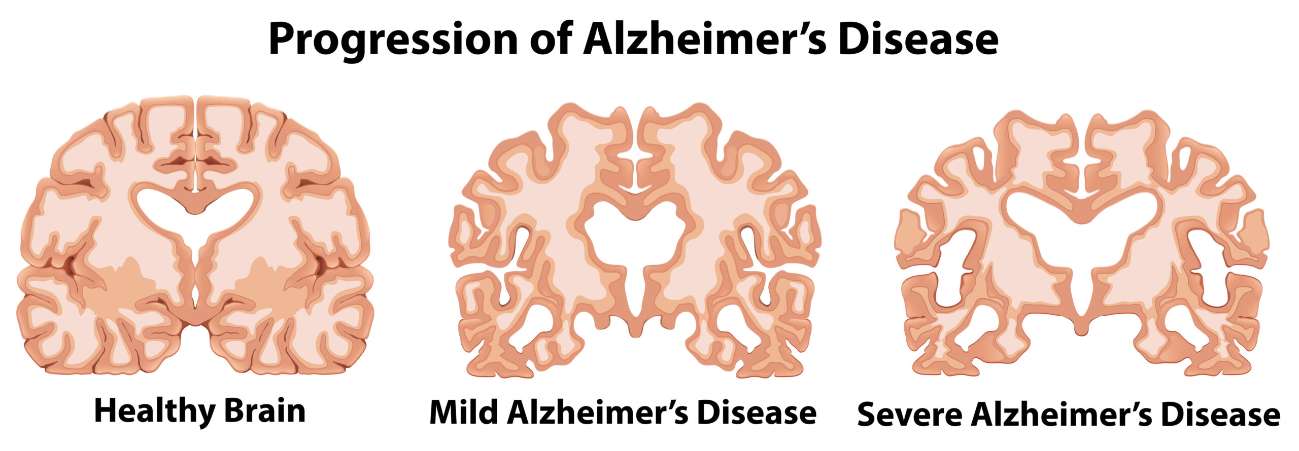 illustration showing healthy brain dan brain affected by mild and severe Alzheimer's Disease